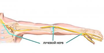 Что нужно знать при защемлении нерва в руке: методы лечения невропатии Защемление лучевого нерва