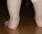 Problèmes avec les jambes des enfants - pieds valgus