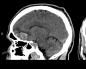 Što je sindrom frontalnog režnja Promjena u psihi s oštećenjem frontalnih režnja