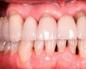 Što učiniti u slučaju povlačenja zubnog mesa, ogolivanja korijena i vratova zuba: uzroci i liječenje kod kuće