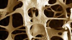 Simptomi in zdravljenje osteoporoze stopala Dejavniki tveganja za osteopenijo in osteoporozo