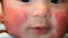Boj proti kroničnim alergijam: atopijski dermatitis pri otrocih Zdravljenje dermatitisa s hrano pri otrocih
