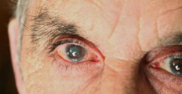 Лікування початкової стадії катаракти: що робити та як зупинити розвиток Принципи консервативної терапії