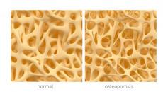 Osteoporoza: što je to, uzroci pojave Osteoporoza kostiju: vrste, simptomi, značajke tijeka bolesti kod žena, dijagnoza