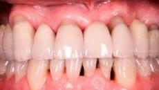 Što učiniti u slučaju povlačenja zubnog mesa, ogolivanja korijena i vratova zuba: uzroci i liječenje kod kuće